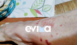 Purple jellyfish spreading across Evia beaches, swimmers stung