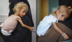 Gaza toddler recovering from severe malnutrition in Italian hospital