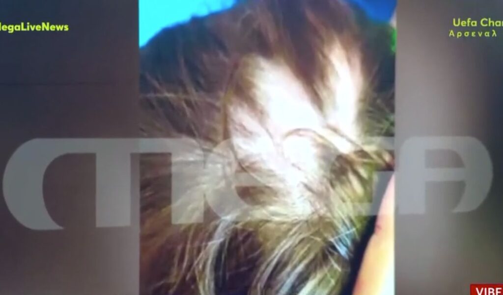 Shocking case in Aulona: Parents of a 2-year-old child reported that their toddler was abused by the daycare director